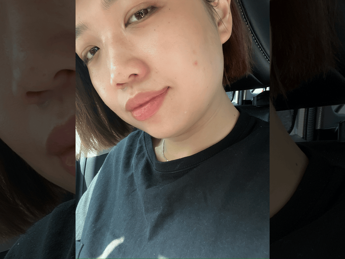 彤顏診所|超真實!雙下巴消失之術!Ronkyla 容脂針初體驗! - 第2張圖