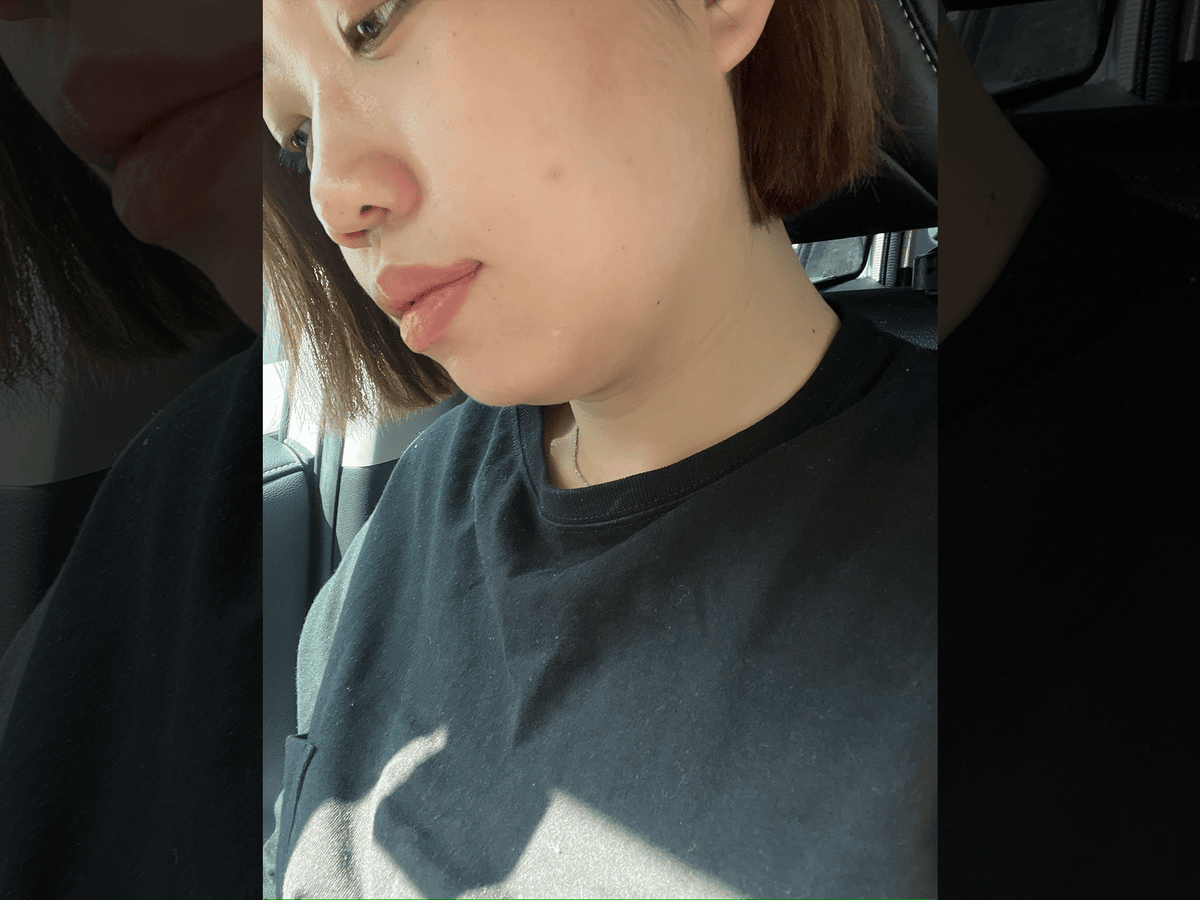 彤顏診所|超真實!雙下巴消失之術!Ronkyla 容脂針初體驗! - 第3張圖